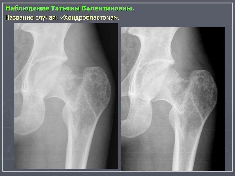 Саркома тазобедренного. Хондросаркома рентген бедренной. Саркома Юинга бедренной кости рентген. Остеосаркома тазобедренного сустава на рентгене. Остеогенная саркома бедренной кости рентген.