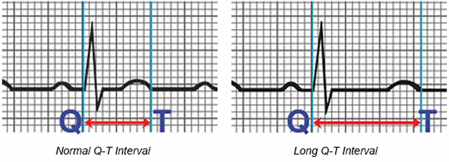 Синдром удлиненного интервала qt на ЭКГ. Синдром удлиненного и укороченного интервала qt. Удлиненный qt на ЭКГ. Синдром укороченного qt на ЭКГ.