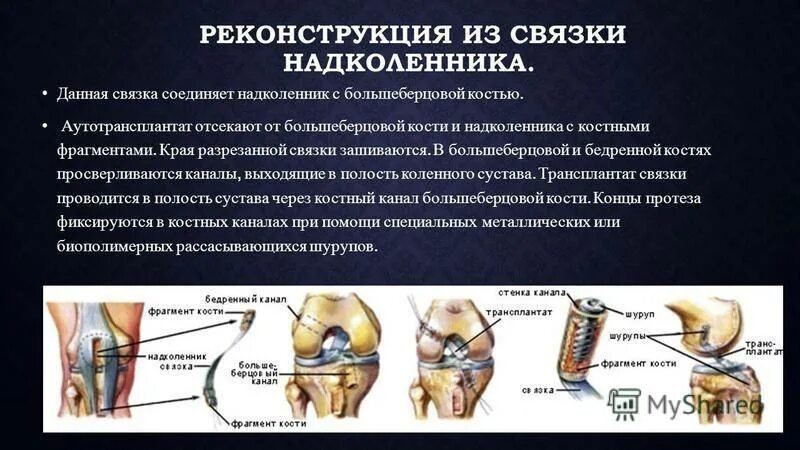 Пластика связок коленного сустава операция. Восстановление ПКС крестообразной связки коленного сустава операция. Связка надколенника. Крестообразные связки надколенника. Время восстановления коленного сустава