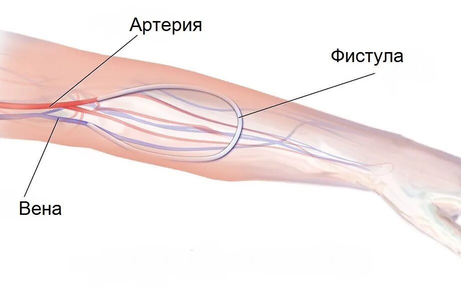 Периферическая вена где. Артериовенозная фистула. Артериовенозная фистула для гемодиализа. Флюстула при гемодиализе.