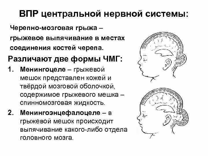 Врожденные пороки развития ЦНС. Пороки развития головного могза. Врожденные пороки развития центральной нервной системы.