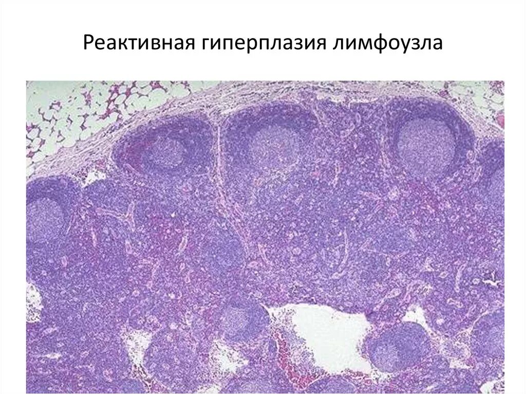 Реактивные изменения лимфатических узлов. Гиперплазия лимфатического узла гистология. реактивная гиперплазия лимфоузла микропрепарат. гиперплазия лимфатического узла микропрепарат. реактивная гиперплазия лимфатических узлов микропрепарат.