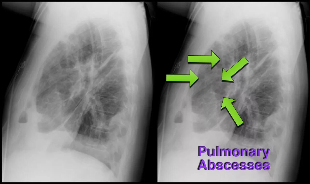 После абсцесса легкого. Абсцесс на рентгенограмме. Абсцесс лёгкого рентген. Рентген при абсцессе легкого.