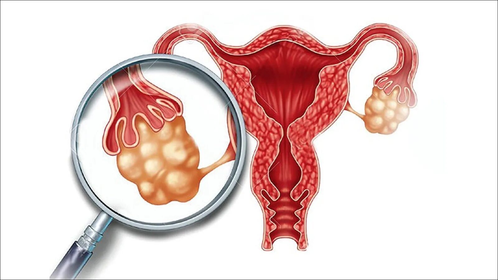 Поликистозные яичники лечение. Синдром поликистозных яичников (PCOS.