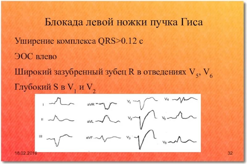 Блокада qrs. Блокада левой ножки пучка Гиса на ЭКГ. Полная блокада левой ножки пучка Гиса зубец s v5-v6. ЭОС при блокаде левой ножки пучка Гиса. Блокада левой ножки ножки пучка Гиса.