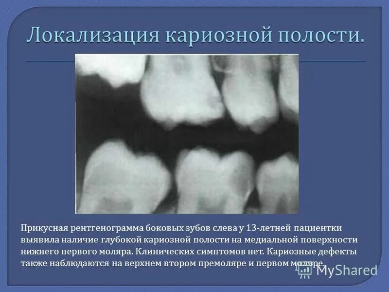 кариозную полость выявляют. раскрытие кариозной полости. этапы препарирования кариозных полостей 1 класса по блэку. препарирование кариозных полостей. вскрытие и раскрытие кариозной полости.