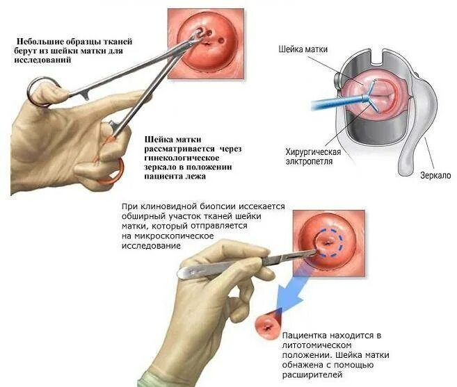 После биопсии шейки нельзя. Биопсия шейки матки протокол операции. Конхотом для биопсии шейки матки. Шейка после биопсии шейки матки матки. Коническая биопсия шейки матки.