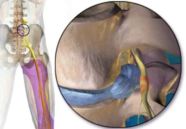 Половой нерв симптомы у женщин. Ишиас - защемление седалищного нерва. Защемление седалищного нерва s1. Ишиас тазобедренного сустава симптомы. Радикулопатия седалищного нерва.