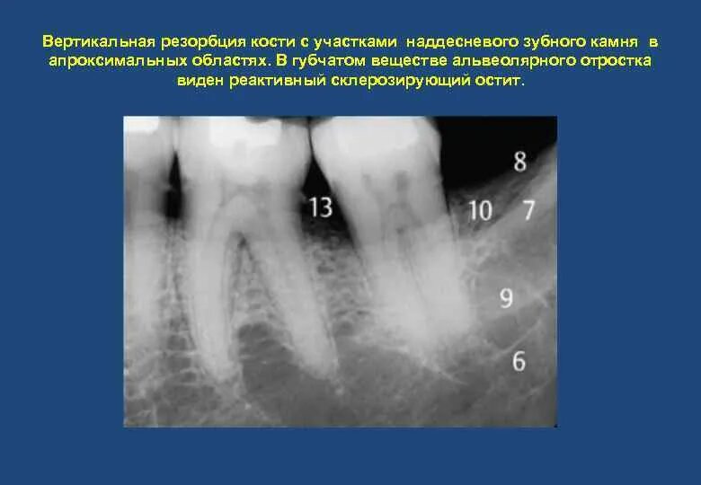 Маркер костной резорбции. Резорбция кости остеокластами. Ремоделирование костной ткани резорбция. Резорбция костной ткани зуба рентген. Костная резорбция челюсти.