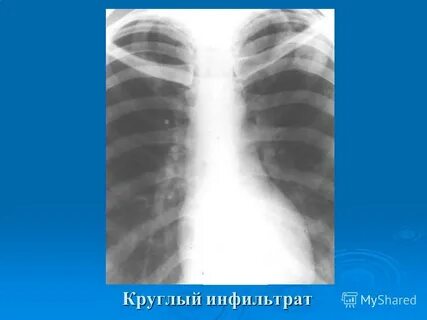 Что такое инфильтрат