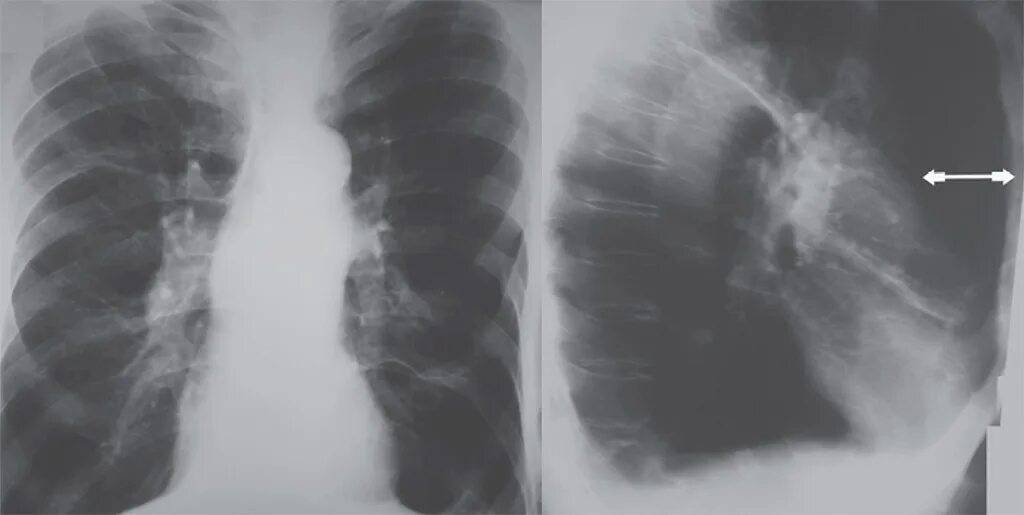 рентген бронхоэктатической болезни. рентгенограммы заболеваний легких. рентген при бронхитическом хобл. рентгенограммы заболеваний легких. ковид пневмония рентген.