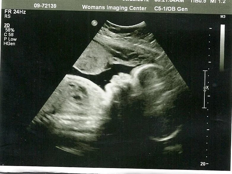 Снимок УЗИ 33 недели беременности. УЗИ плода на 34 неделе беременности. УЗИ 34 недели беременности фото. УЗИ ребенка на 34 неделе беременности.