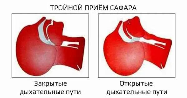 Тройной прием алгоритм. Тройной прием Сафара алгоритм. Продемонстрируйте тройной прием Сафара. Прием Сафара техника выполнения.