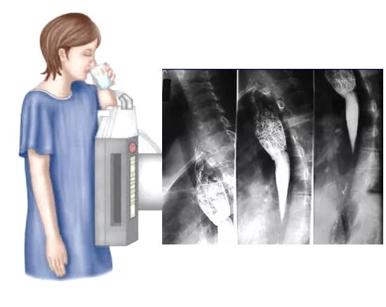 Рентгенологические исследования пищевода с бариевой взвесью. Рентген исследование желудка с барием. Подготовка к рентгеноскопии пищевода с барием. Рентгенография пищевода с барием.