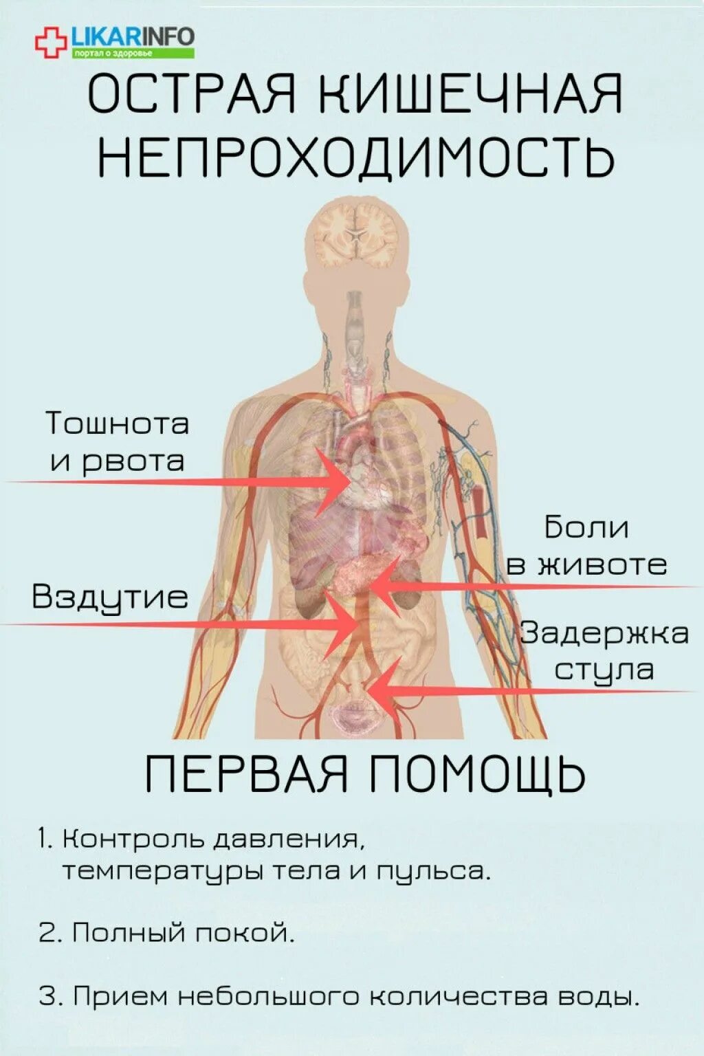 Острая кишечная непроходимость симптомы. Кишечная непроходимость симптомы. Признаки острой непроходимости кишечника. Симптомы при острой кишечной непроходимости. Признаки непроходимости кишечника у взрослых какие симптомы