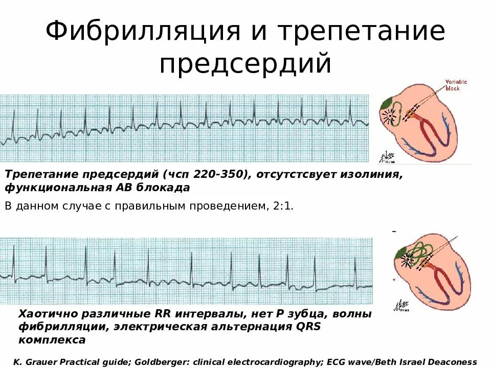 Фибрилляция предсердий тахиформа. Фибрилляция и трепетание предсердий. фибрилляция предсердий и трепетание предсердий различия. фибрилляция и трепетание на экг. фибрилляция предсердий сердца экг.