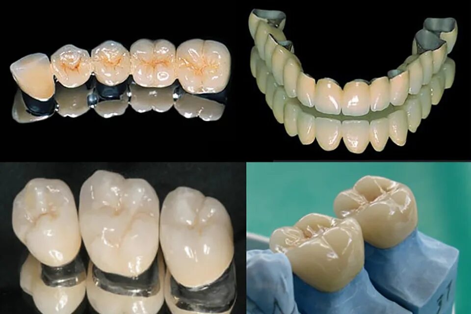 Коронки из каких материалов бывают. Металлокерамика vs безметалловая керамика. Металлокерамическая коронка Дуцерам. Коронку несъемную металлокерамика. Металлокерамика мостовидные протезы.