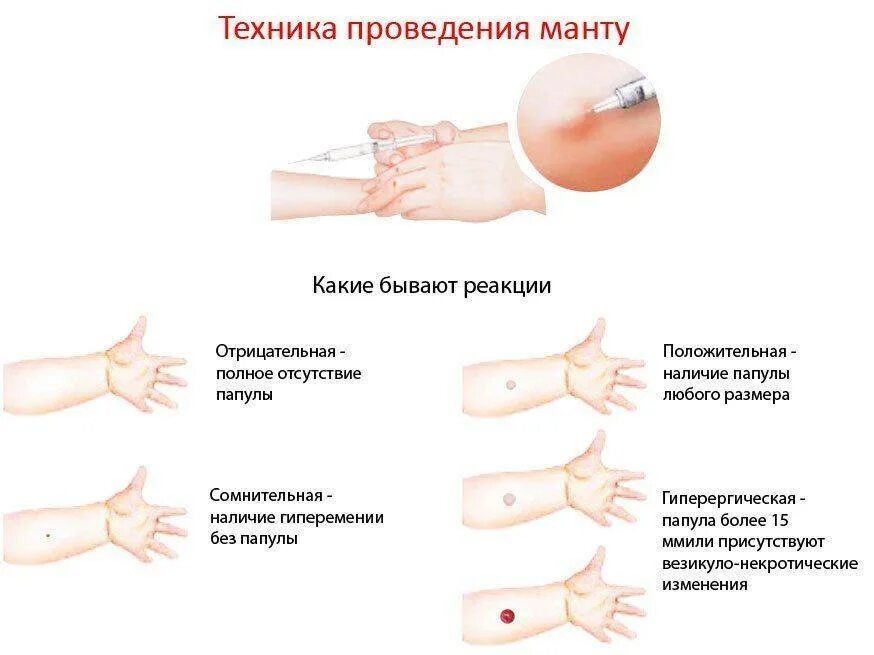 Виды реакций на пробу манту. Реакции манту папулы норма. Реакция манту методика проведения. Реакция манту норма у детей 8 лет. Сколько норма манту