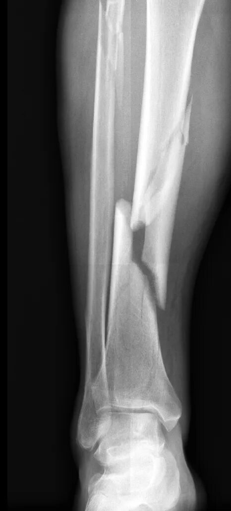 Трещина кости на ноге. Бамперный перелом голени рентген.