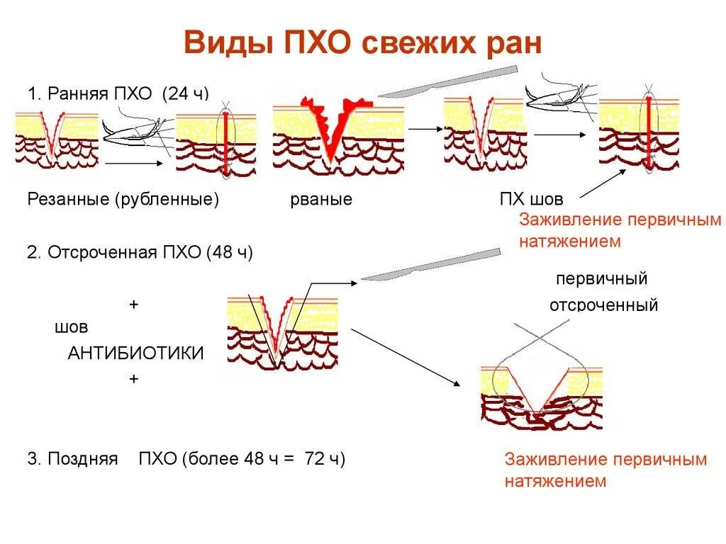 Типы хирургической обработки раны. Первичная хирургическая обработка раны виды. Заживление РАН. Фазы заживления РАН. Первичная хирургическая обработка наложение швов. Как называется шов после операции