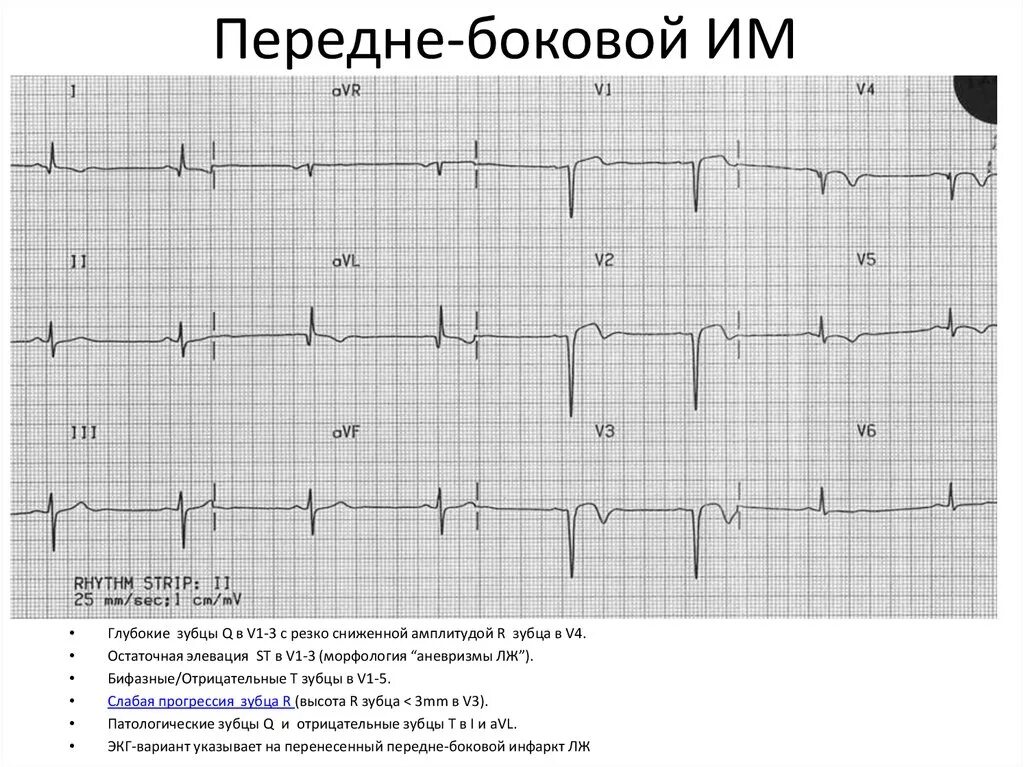 Острый инфаркт миокарда передней стенки ЭКГ. Инфаркт миокарда высоких боковых отделов левого желудочка на ЭКГ. Инфаркт миокарда боковой стенки на ЭКГ. Инфаркт миокарда боковой стенки левого желудочка на ЭКГ. Очаговые изменения желудочка