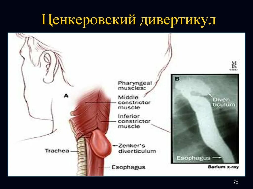 Нормальный пищевод. Дивертикул пищевода рентген. Глоточно пищеводный дивертикул Ценкера. Дивертикулы пищевода клиника. Шейный дивертикул Ценкера.