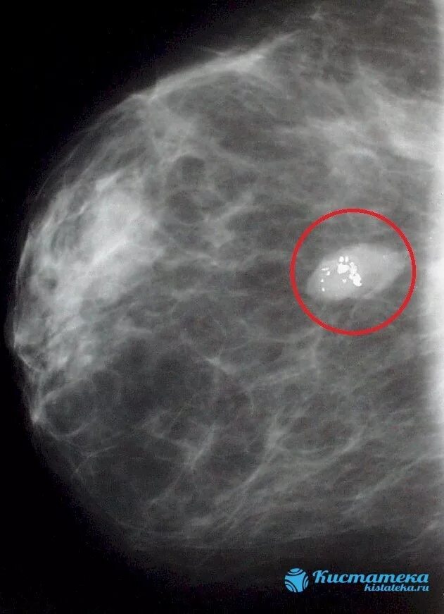 фиброаденомаммолочной железы. фибролипома маммография. железистая фиброаденома молочной железы. узловая мастопатия на маммографии. фиброаденоз маммография.