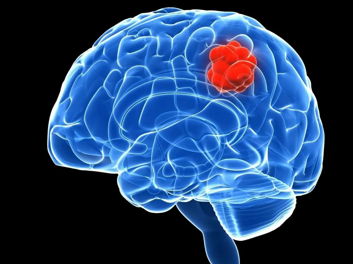 Злокачественное новообразование головного мозга. Опухоль мозга глиобластома. Опкхолльлголовного мозга. Доброкачественная опухоль мозга. Что такое глиома