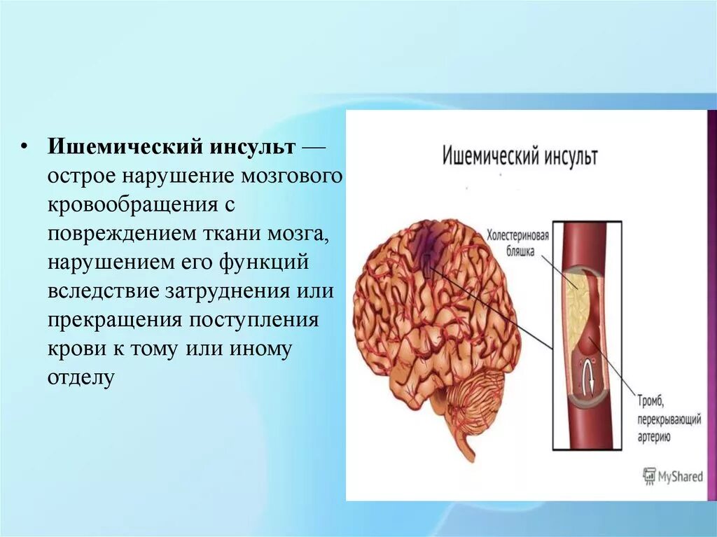 Что такое ишемический инсульт головного мозга