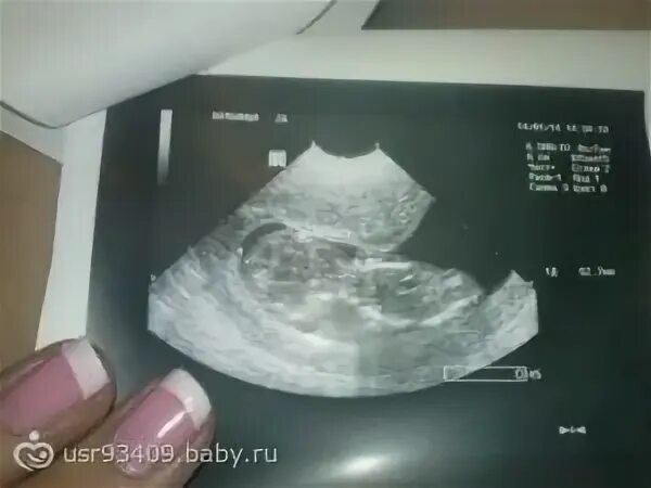 Замер на 6 неделе форум