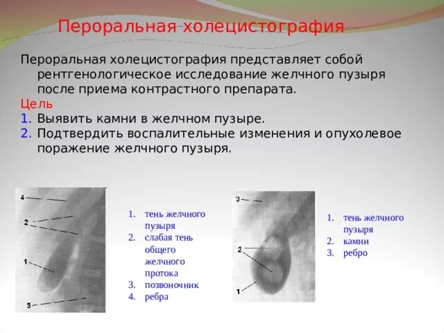 Пероральная холецистография. Внутривенная пероральная холецистография. Холецистография метод исследования. Холецистография проводится с целью подтверждения заболеваний. Рентген исследование желчного пузыря.