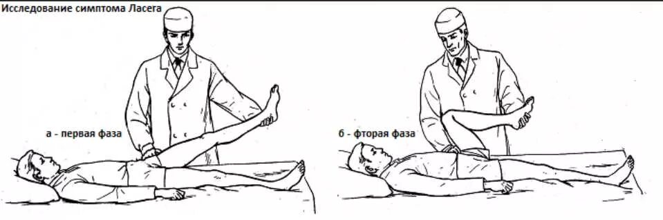 Симптомы натяжения: Нери, Ласега, Вассермана, Мацкевича.. Нери Ласега Вассермана. Симптомы натяжения Ласега Нери. Симптом натяжения Ласега Нери Вассермана. Симптом байкова