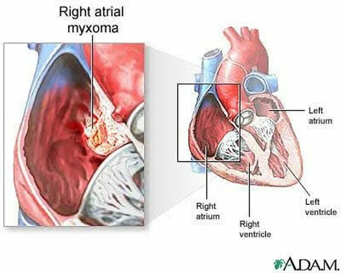 Образование левого предсердия. Опухоль сердца миксома. Доброкачественная опухоль сердца миксома. Объемные образования сердца. Опухоли левого предсердия.
