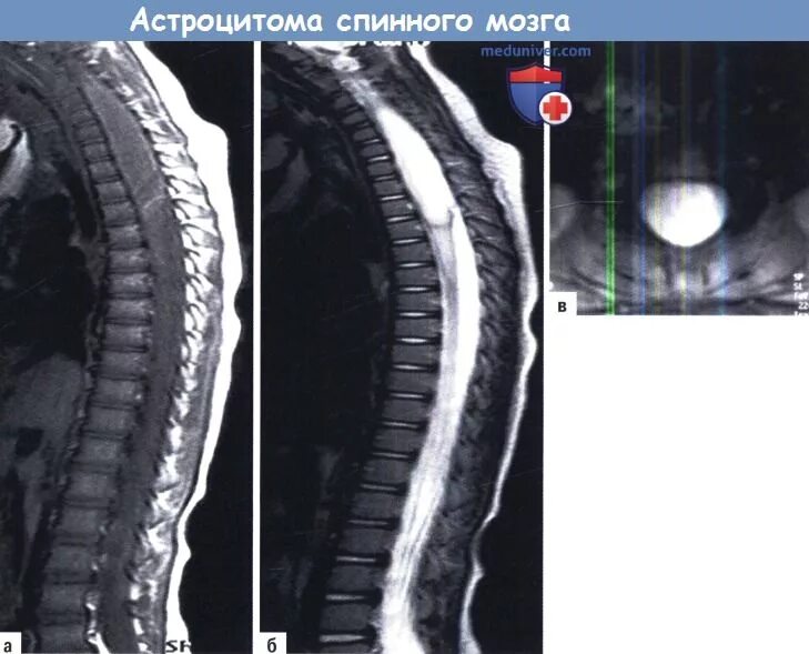 Интрамедуллярная опухоль спинного мозга мрт. Астроцитомама спинного мозга. Субдуральные опухоли спинного мозга. Интрамедуллярная астроцитома мрт. Интрамедуллярные опухоли спинного