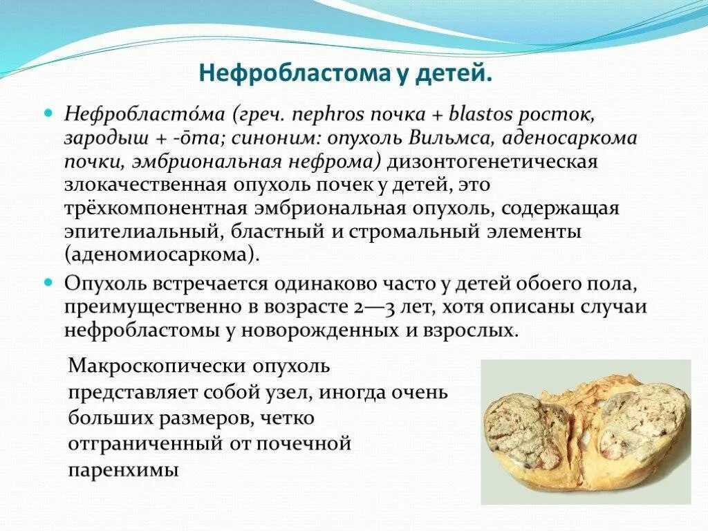 Рак почки причины. Нефробластома (опухоль Вильмса). Опухоль Вильмса (нефробластома) макропрепарат. Эмбриональная нефробластома (опухоль Вильмса).