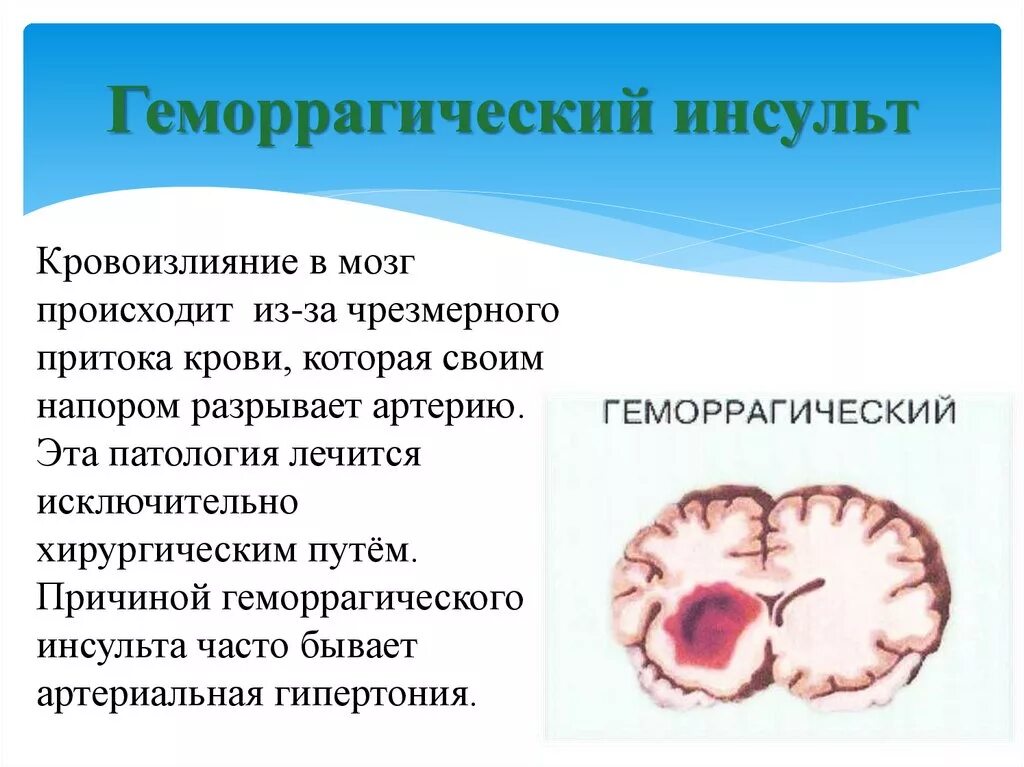 Кровоизлияние ствола мозга. Геморрагический инсульт патанатомия. Геморрагический инсульт микроскопия. Геморрагический инсульт патологическая анатомия. Патологическая анатомия ишемического инсульта.