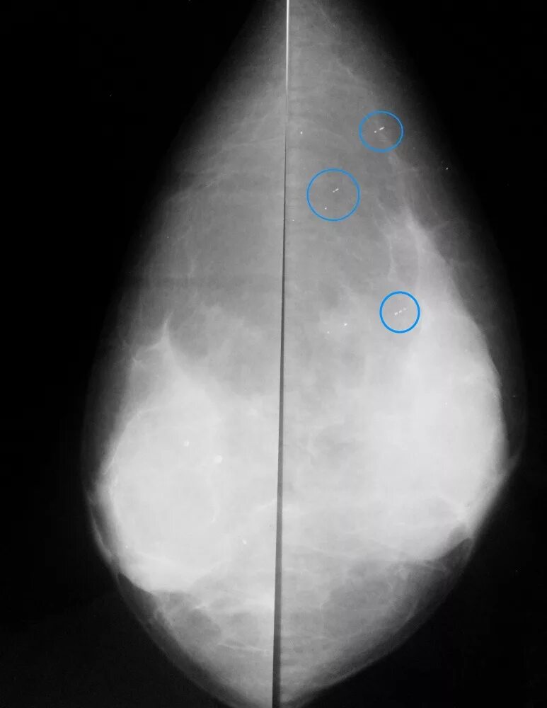 Округлые кальцинаты. Галактоцеле на маммографии. Маммограмма норма рентген. Галактоцеле молочной железы маммография. Кальцинаты маммограмма.