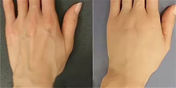 Рецензия рука. Плазмолифтинг для кожи рук. Плазмотерапия кистей рук.