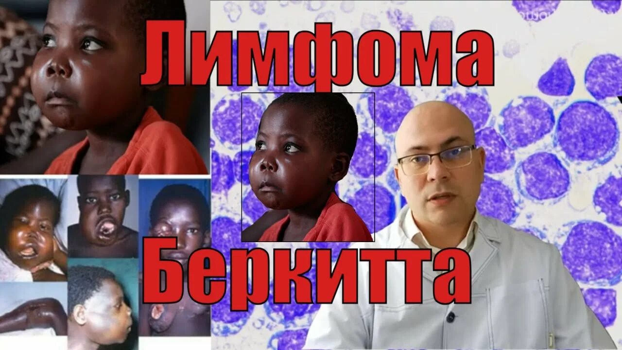 Степени распространения лимфомы" - картинка из статьи: "Диагностика и лечение ли