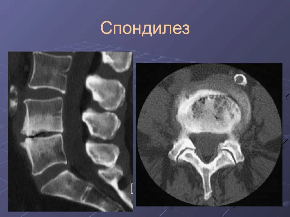Спондилез на кт. Спондилёз поясничного отдела позвоночника на кт. Спондилез степени на кт. Спондилез позвоночника кт. Картина спондилеза