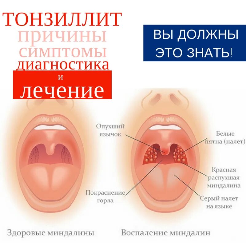 Хронический тонзиллит симптомы. Гнойное воспаление миндалин. Ангина, фарингит, тонзиллит симптомы. Лечение ангины гнойной у взрослых эффективные