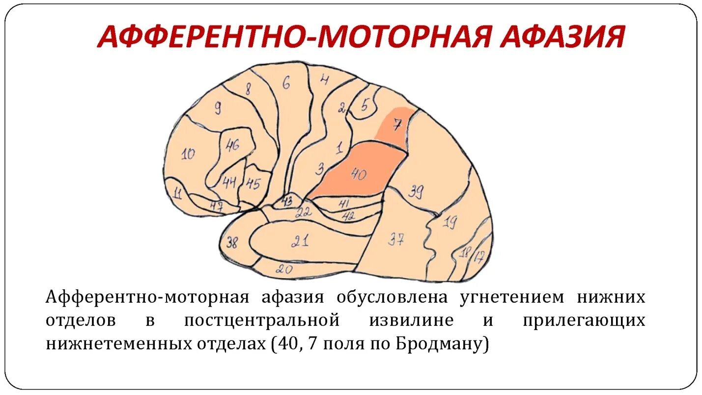 Очаги в коре головного мозга. Локализация поражения при эфферентной моторной афазии. Поражения при афферентной моторной афазии. Афферентная моторная афазия очаг поражения. Очаг поражения при моторной афазии.