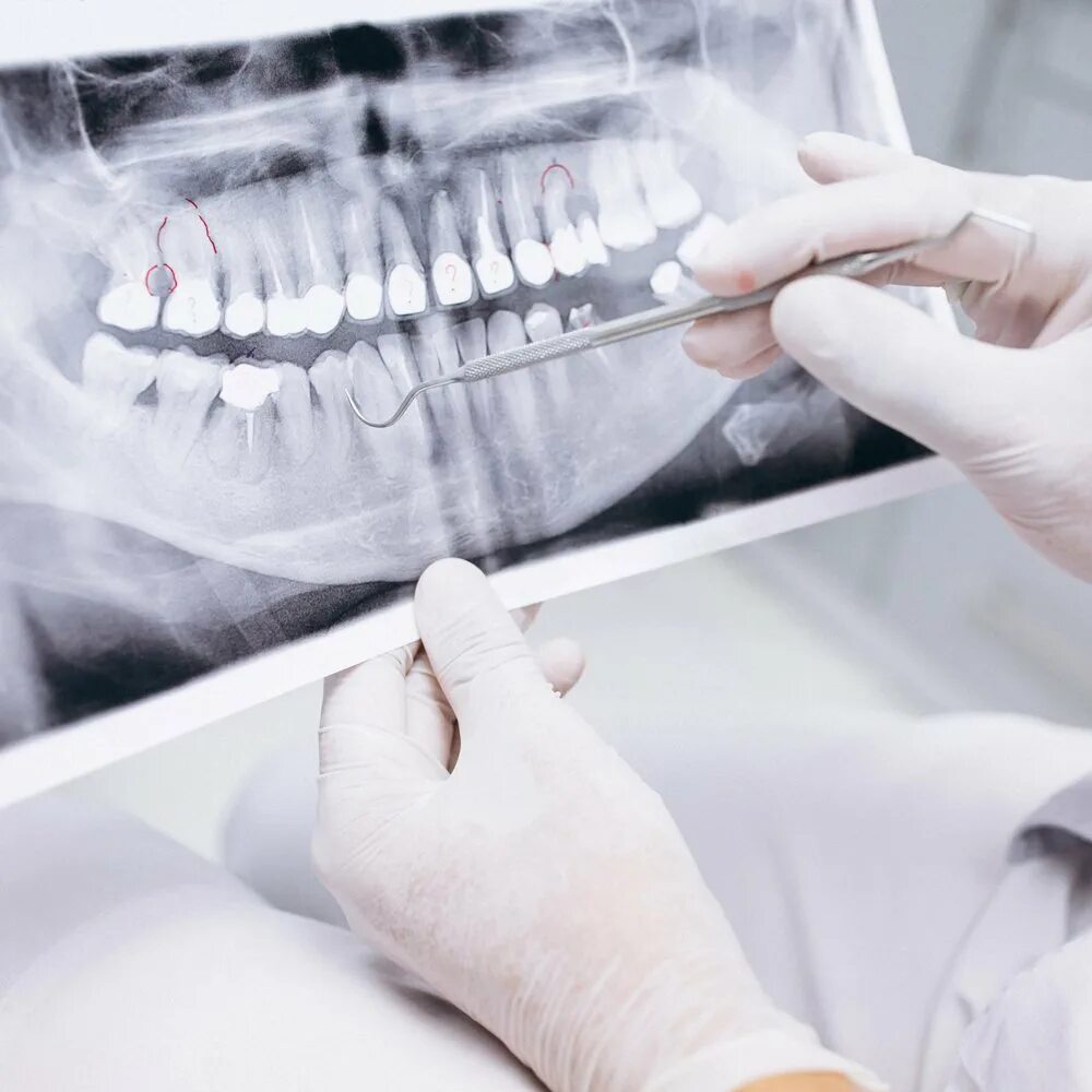 Где сделать кт зуба. Что такое снимок ОПТГ В стоматологии. Рентген ортопантомограмма зубов. Панорамный снимок челюсти (ОПТГ).