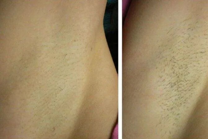подмышки до и после лазерной эпиляции. лазерная эпиляция до и после. лазерная эпиляция бикини. лазерная эпиляция до и после. лазерная эпиляция подмышки.