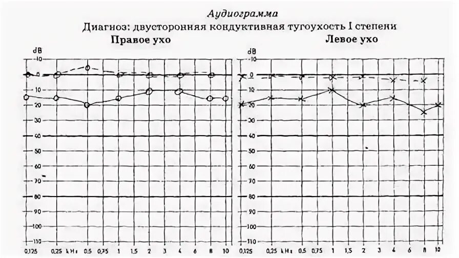 Кондуктивная тугоухость 2 степени аудиограмма. Аудиограмма при 1 степени тугоухости. Аудиограмма при 4 степени тугоухости. Аудиограмма при нейросенсорной тугоухости 1 степени. Аудиограмма степени