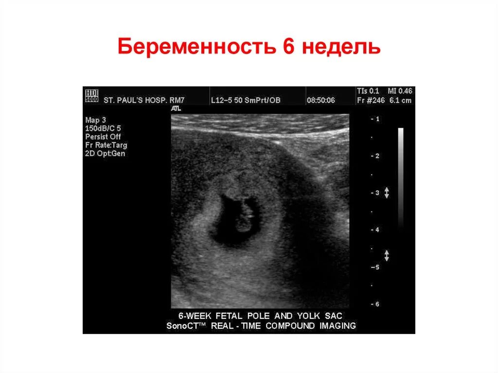 6 Недель 5 дней беременности. 6 Недель и 1 день беременности. 6 Недель 2 дня беременности. 6 недель беременности что происходит с мамой