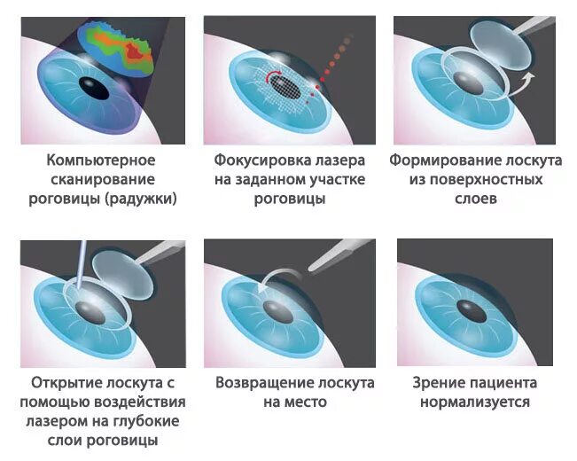 Коррекция зрения сравнение