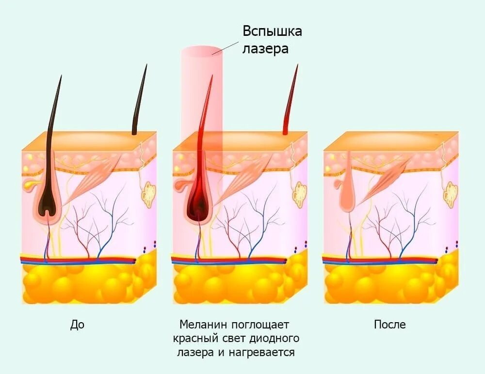 Лазерная эпиляция. Длина волны лазера для эпиляции. Лазерная эпиляция лазер. Мощность лазерной эпиляции. Глубина воздействия лазера для эпиляции.