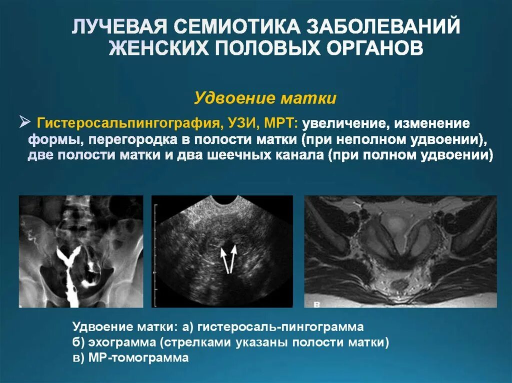 Лучевая семиотика заболеваний женских половых органов. Патология развития женских половых органов. Аномалии развития половых органов. Аномалии развития и положения женских половых органов