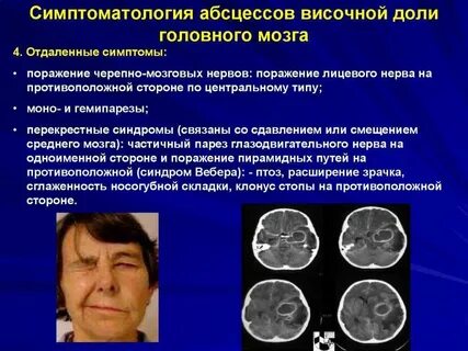 Абсцесс головного